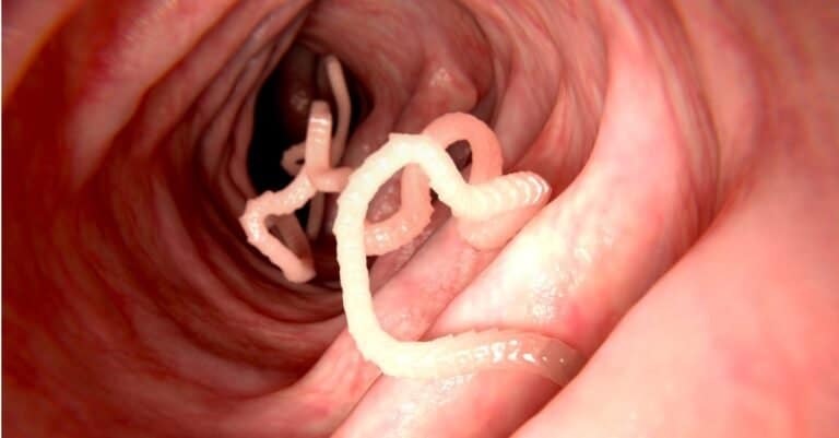 Tape worms in a human intestine.