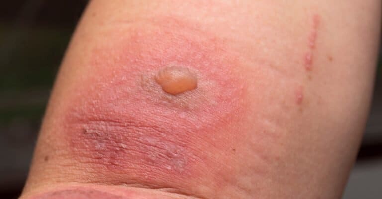 Blister Beetle blister on skin
