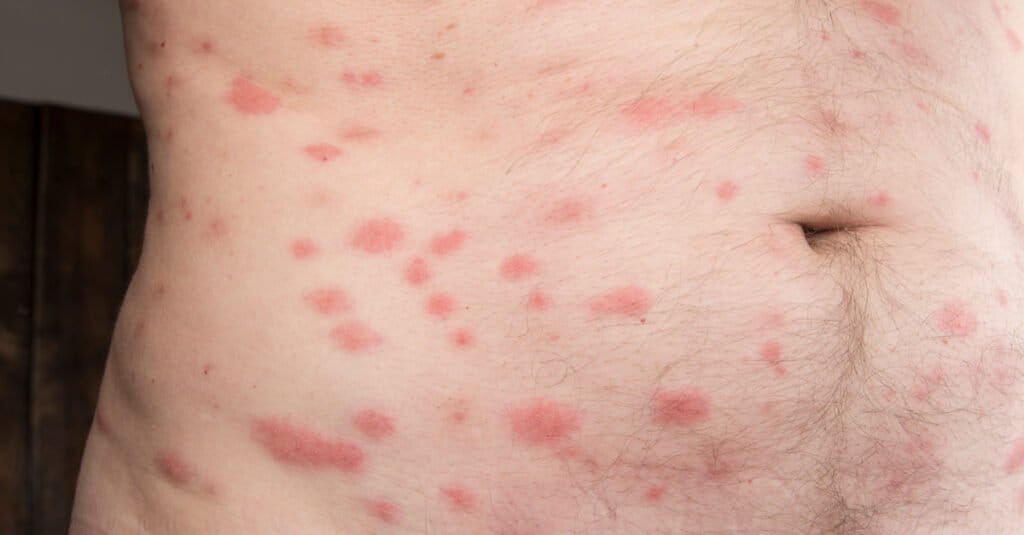 bed bug bites