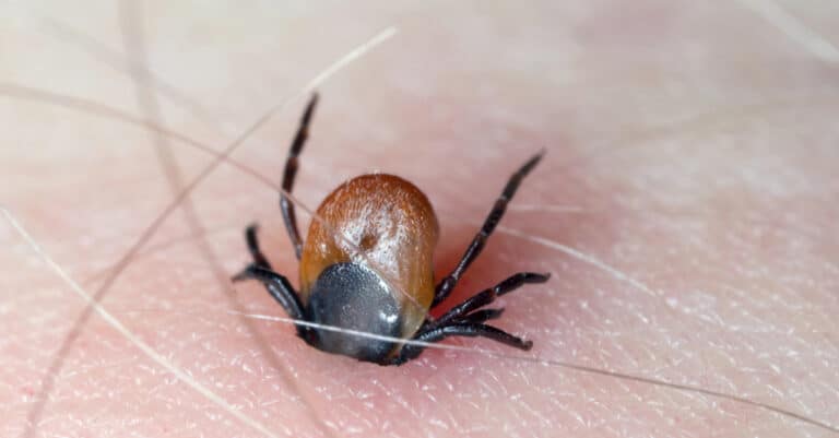 A Deer Tick with its chelicerae sticking in human skin.