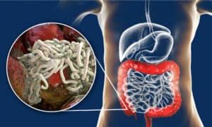 8 Natural and Effective Ways to Get Rid of Pinworms Picture