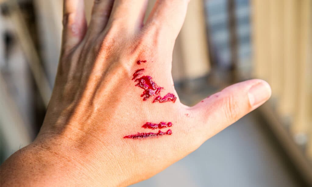 Human hand with wounds from a dog bite