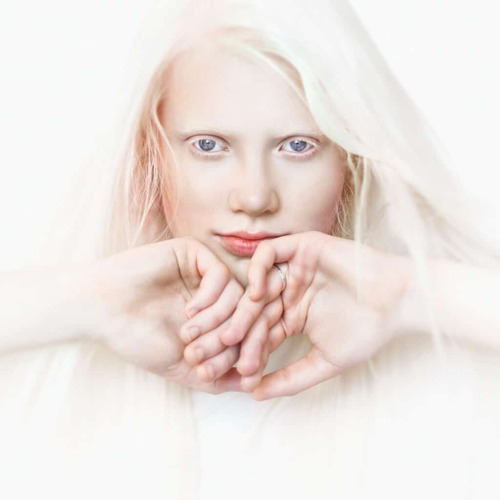 Head shot d'une jeune femme atteinte d'albinisme 