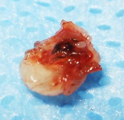 A close up of a tunga penetrans that was removed from beneath a person's skin. It's rather bloody. On some sort of surgical blue background. 