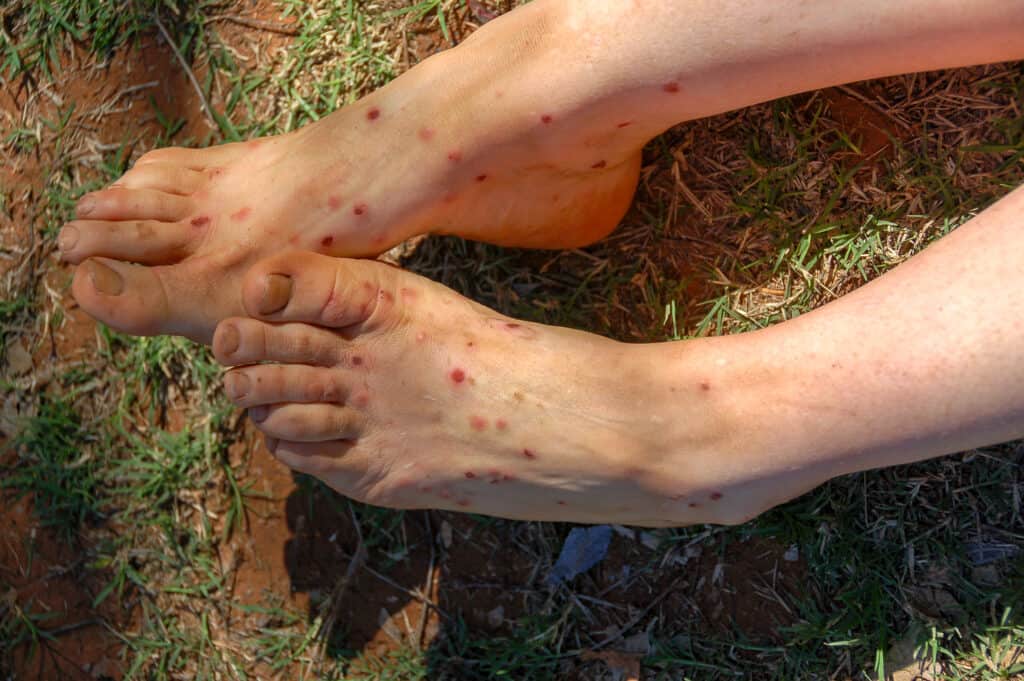 Courtesy of the photographer: Hundreds of mosquitoes (or sandflies) bite the feet and legs of a mosquito-bitten woman in Western Australia. Her legs and feet are very light colored with many red spots. Her second toe is the longest toe on her Esch foot. The background is tightly trimmed grass.