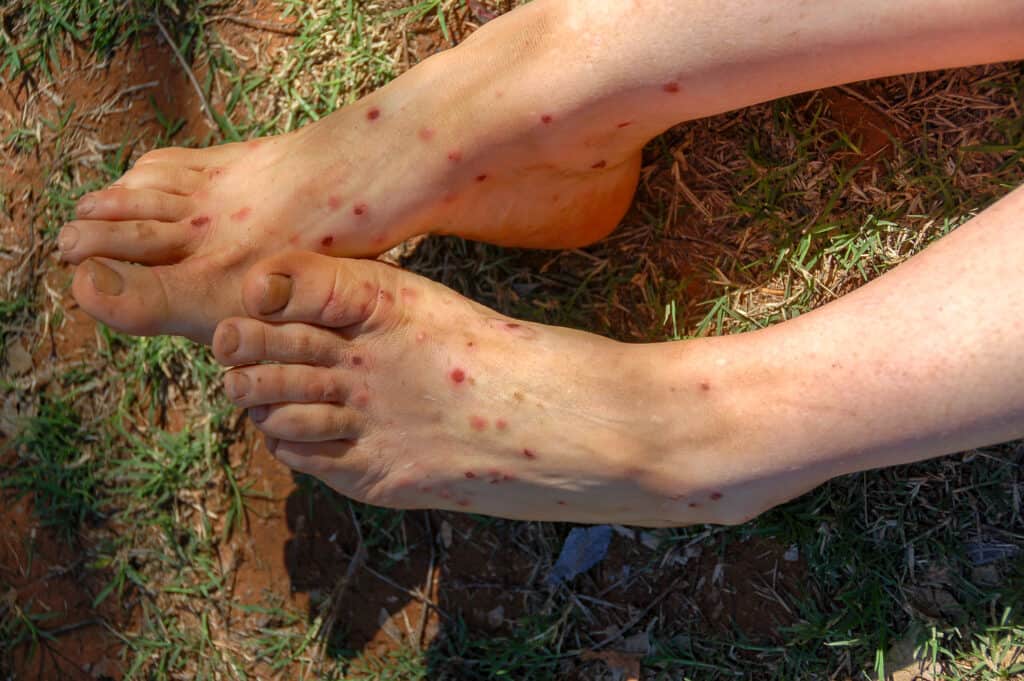 sand flea bites on feet