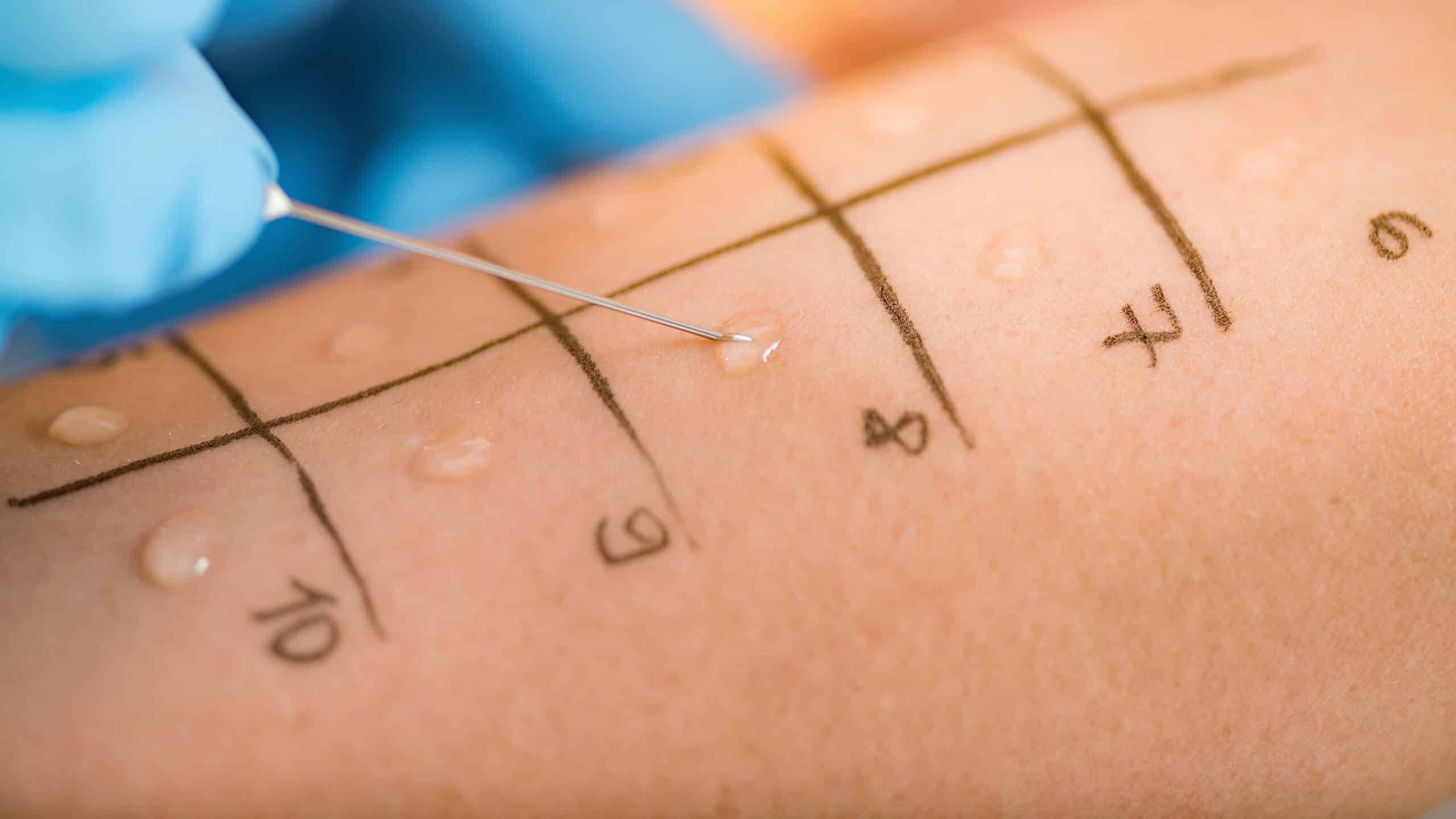 Allergy Test