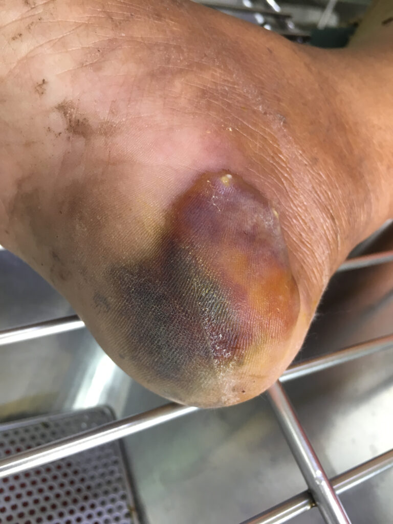 Rattlesnake bite