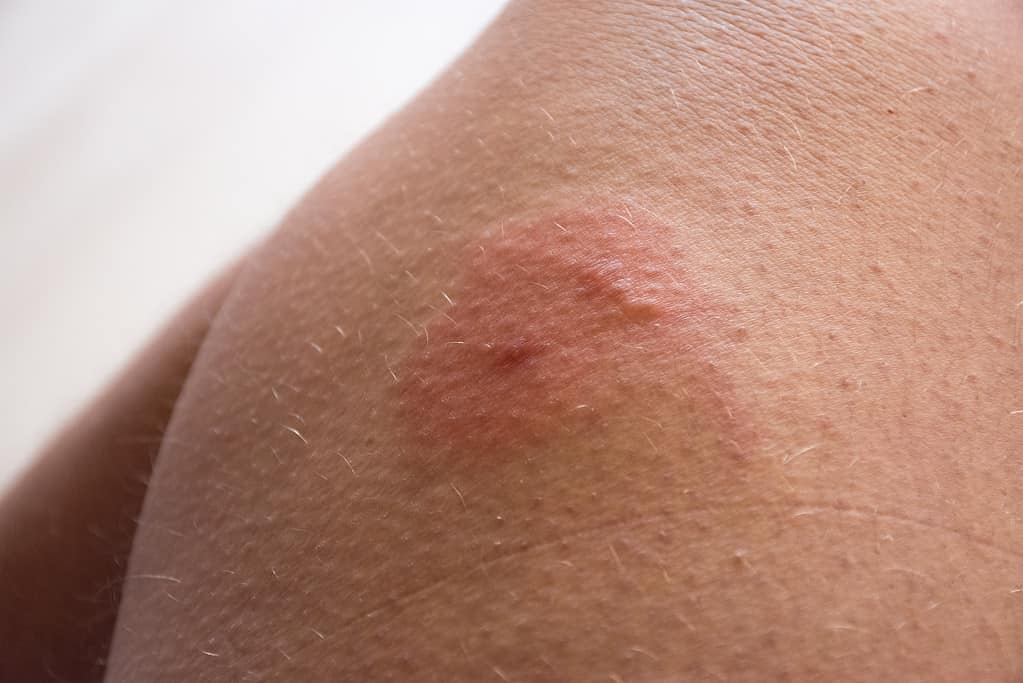 Photo of insect bite on skin. Double  insect bite (bee,wasp,horsefly) with redness, inflammation area and allergic swelling or edema on human skin. Signs and symptoms of skin lesions using bug stings