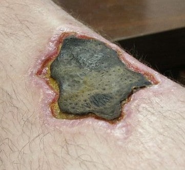 brown recluse bite pictures timeline