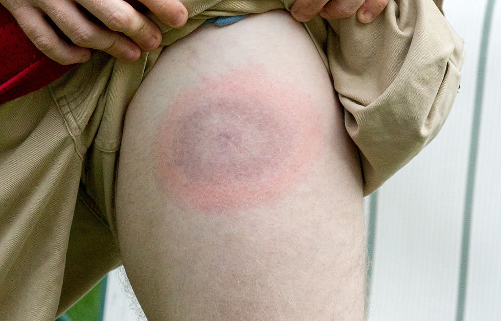 Lyme disease bulls eye rash