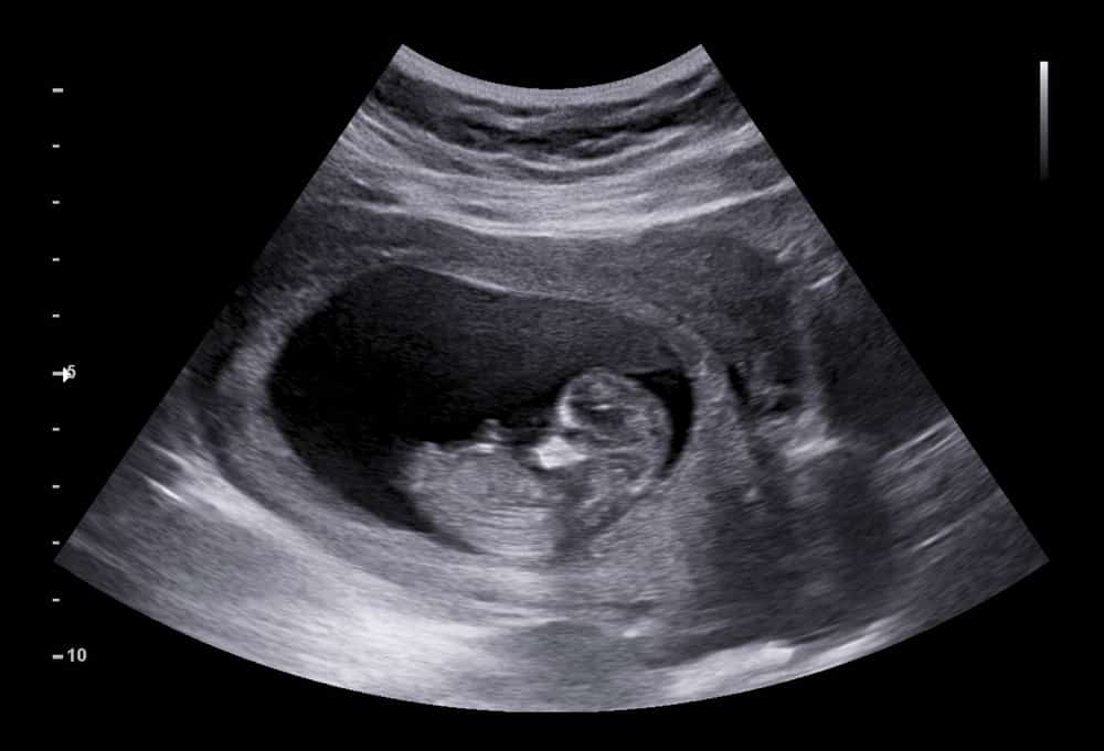 Ultrasound small baby at 12 weeks. 12 weeks pregnant ultrasound image show baby or fetus development and pregnancy health checking.