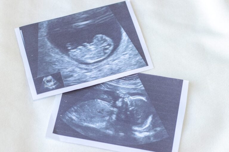 ultrasound pictures shows different gestational periods. sonogram of fetus, unborn yet baby, on white textile surface and blue heart means it's a baby boy. toy for teeth and white cotton bib. flat lay