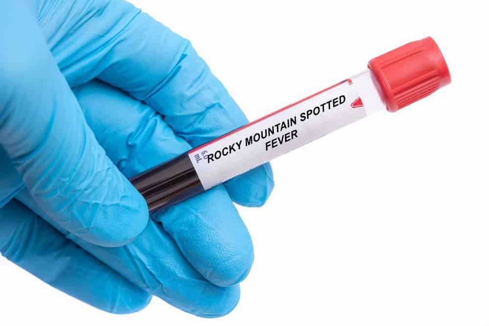 Rocky Mountain spotted fever