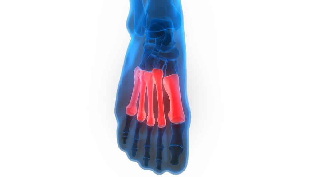 Human Metatarsal Bones. Most of the bones in the foot are shown in blue, but the metatarsal bones ar magenta (pink). There are five of them.