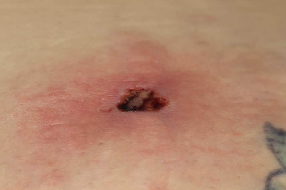 brown recluse bite pictures timeline