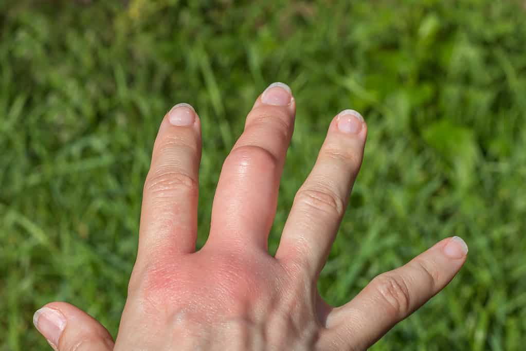 fragment of right hand with a swollen large middle finger after a bee bite on a green background, bigger due to allergy reaction after a wasp sting, red sensation on palm, finger wounded, skin irritation