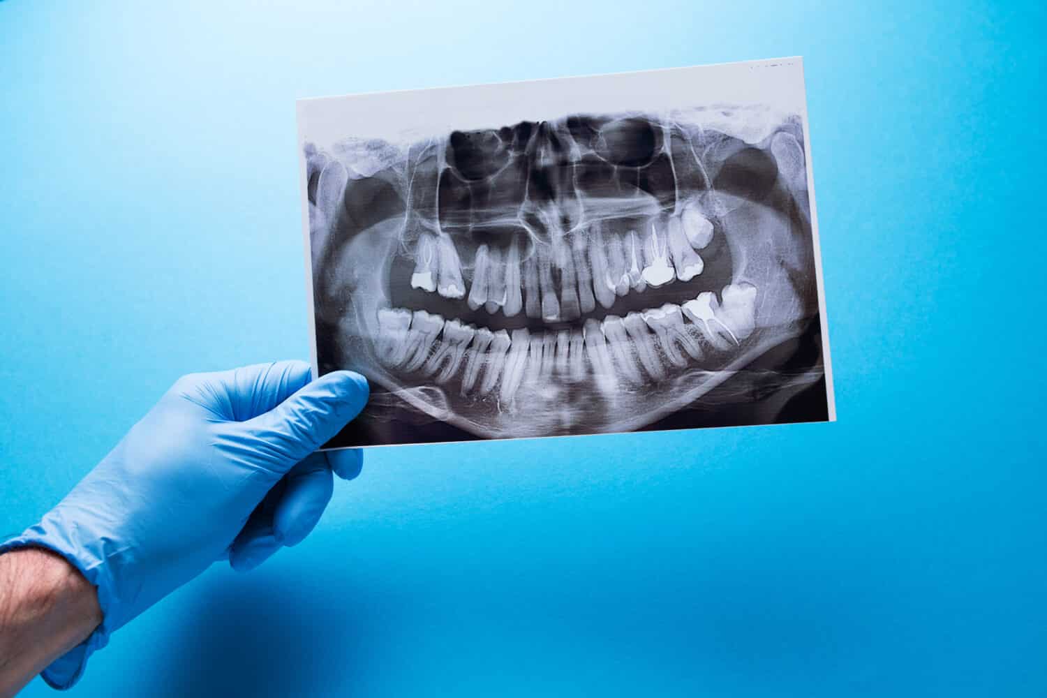 A dentist holding snapshot the patient's tooth and indicates the problem. Panoramic shot of the jaw on a blue isolated background.