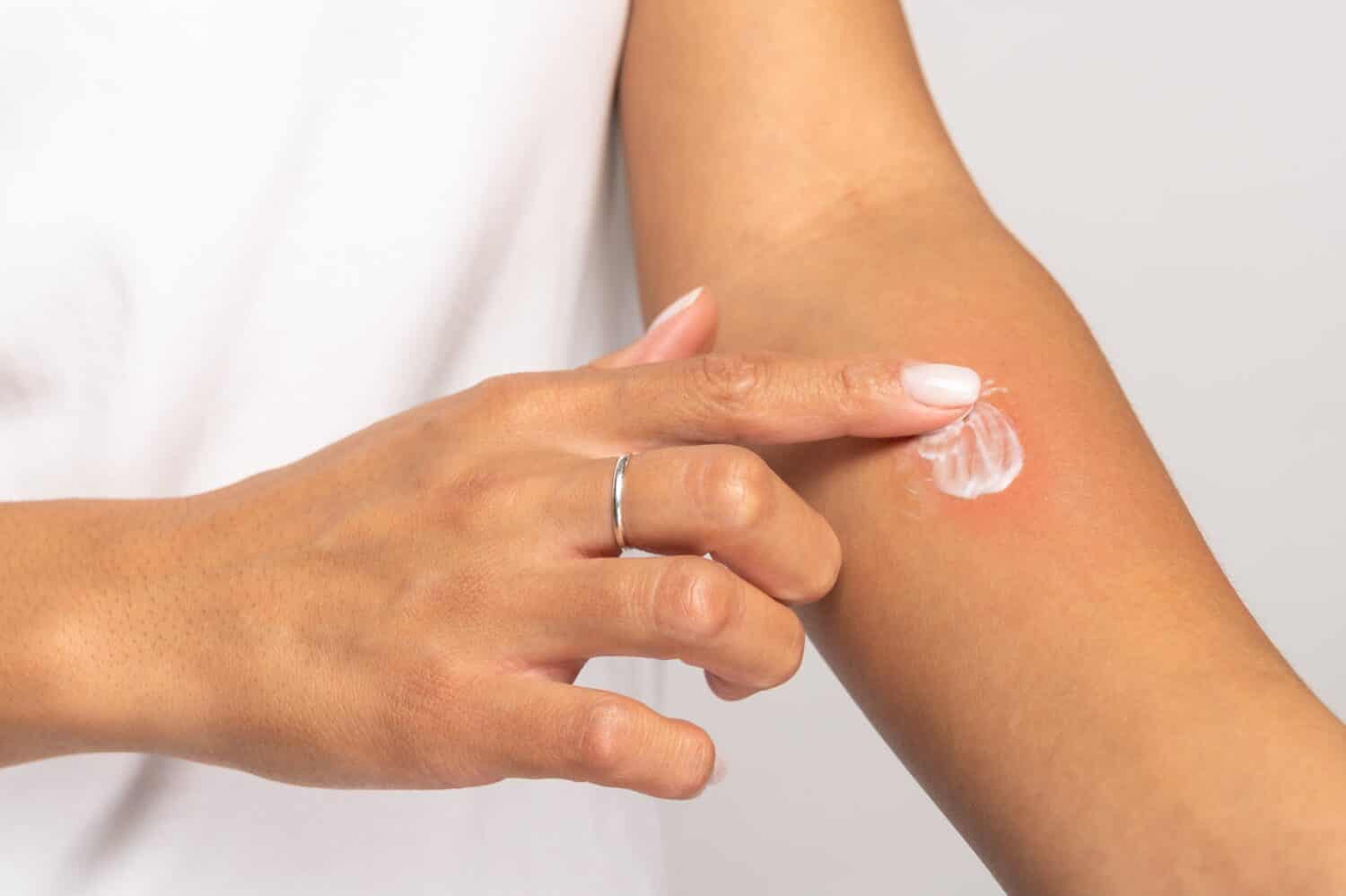 Allergic reaction, itch, allergy, dermatiti concept. Close up of woman applying cream or ointment on swell skin after insect mosquito bites, isolated on grey studio background. 