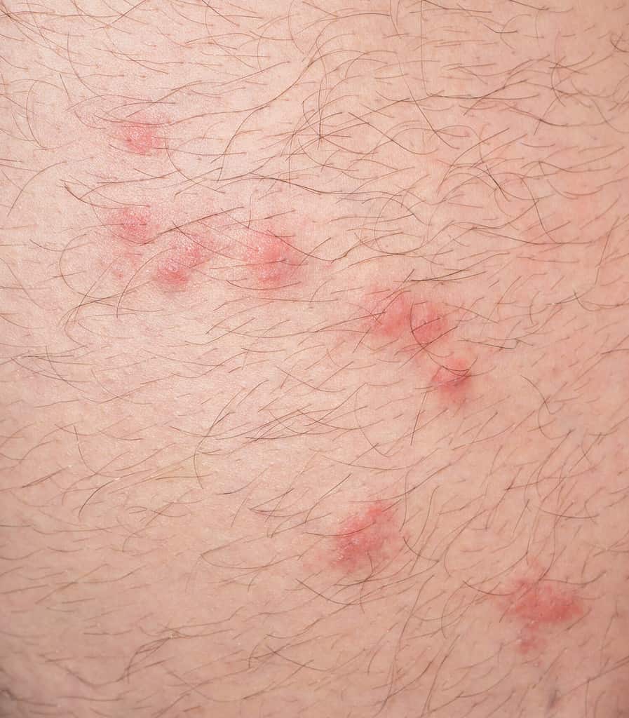 Red insect bites on human