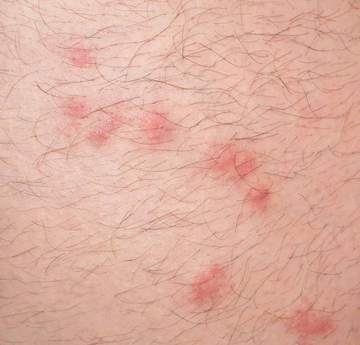 close up view of flea bites over caucasian man leg skin