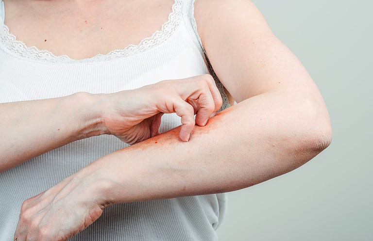 Woman scratching a rash on her arm. Landscape.