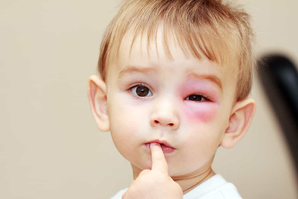  alight-skinned toddler is shown with their left eye swollen and red from a wasp sting.  dangerous stings from wasps near the eye