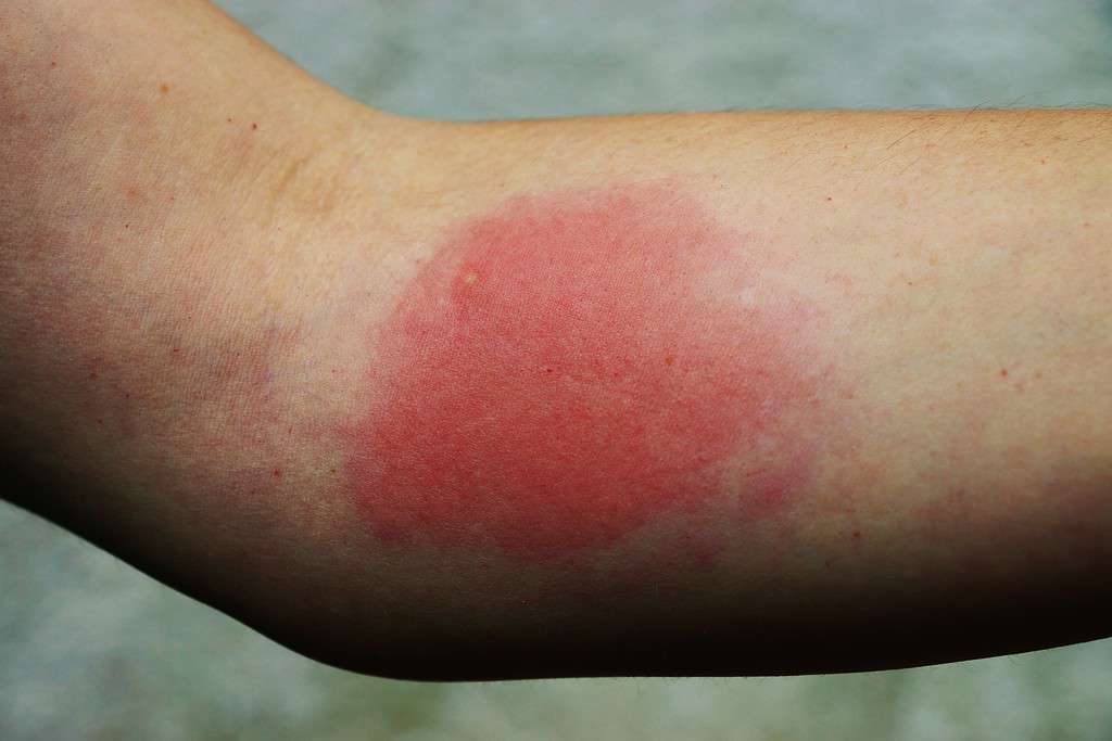 Painful allergic reaction to a wasp sting- A ver red, angry looking blotch on a light-skinned arm. 