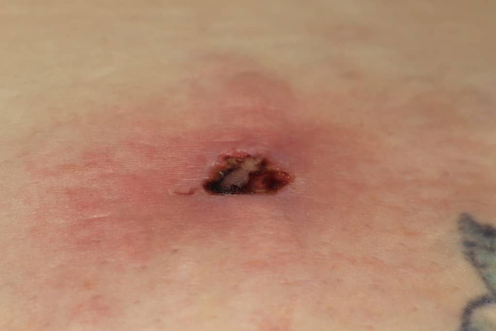 fresh brown recluse bite