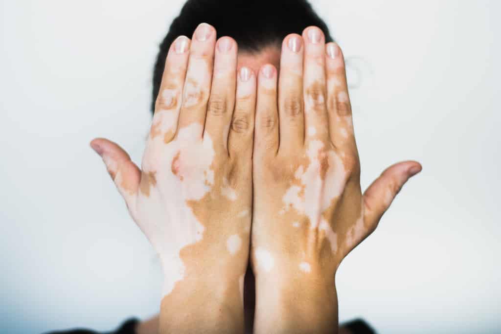 Vitiligo on the hands with white background