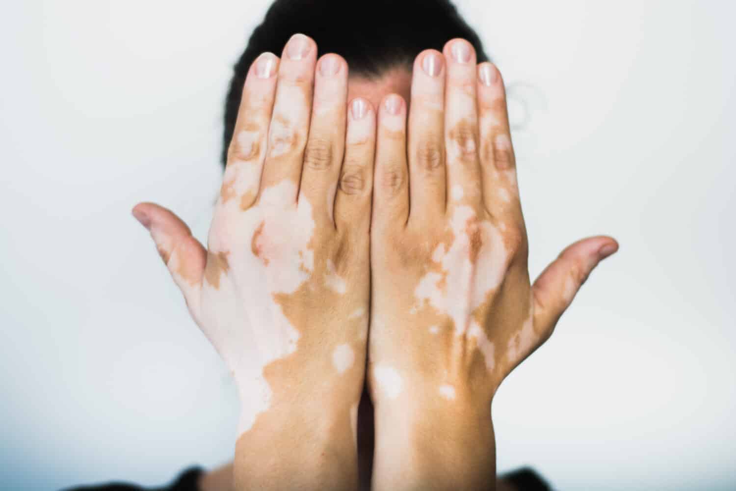 Close-up of hands with vitiligo