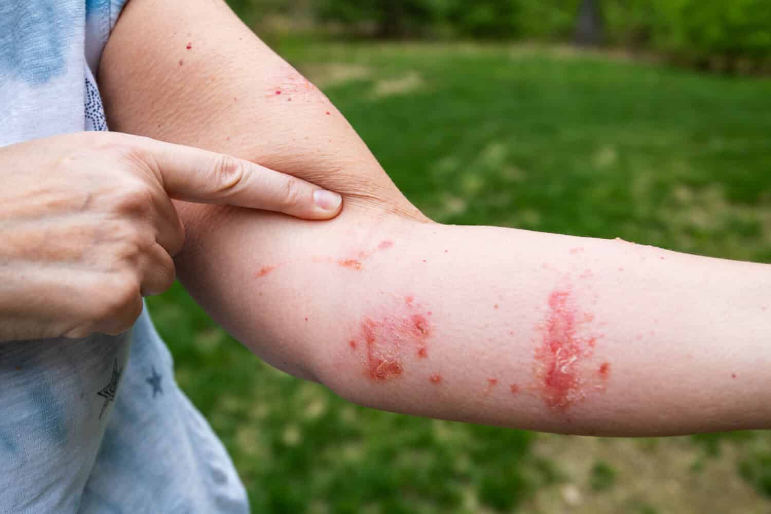 Pointing at itchy poison ivy / poison oak rash and infection with blisters and oozing