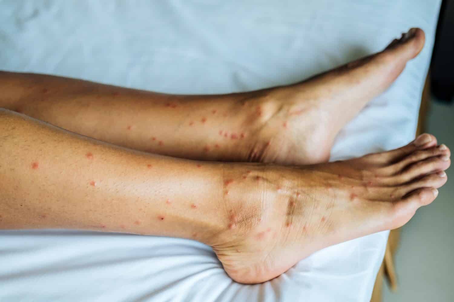 Skin damaged by insect bites. Close up. Skin with many red spot and scar from sand fly bites