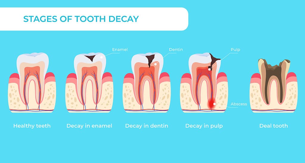 Stage tooth decay infographic medical educational scheme names diagnosis vector flat illustration