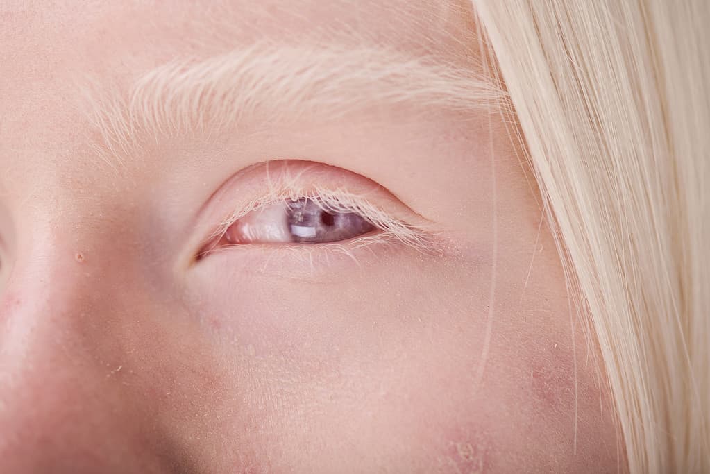 Albino woman with blue eyes