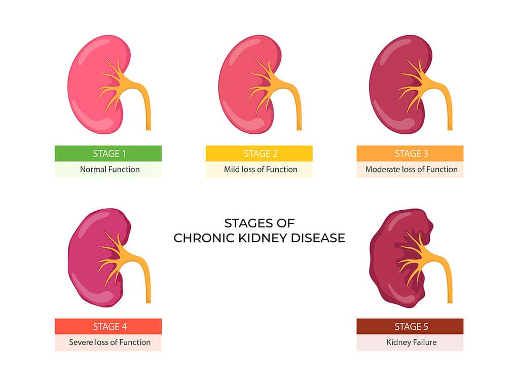 Stages of chronic kidney disease. Problem in urinary system and normal kidney