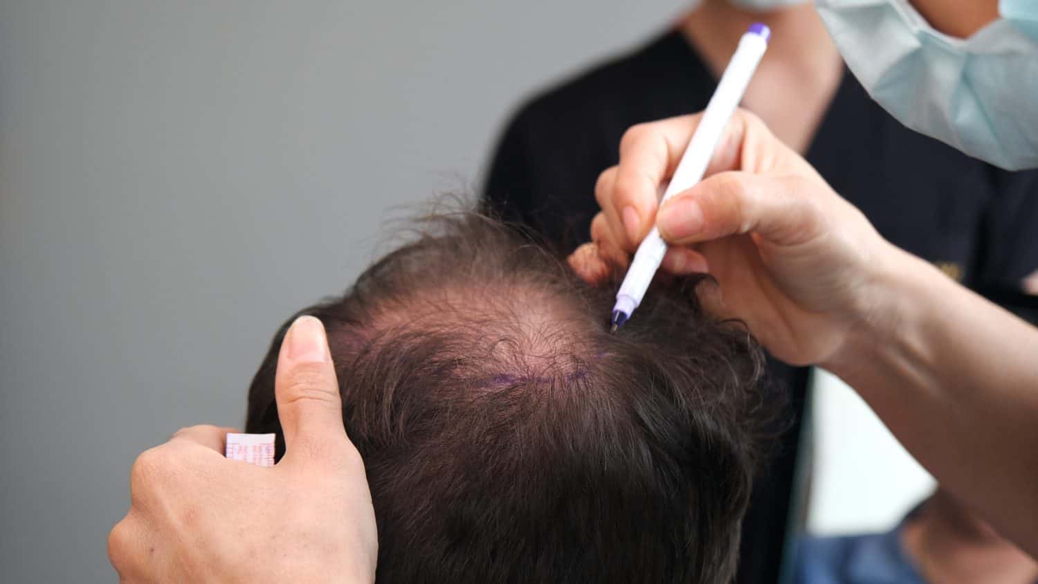 doctor check before hair transplant