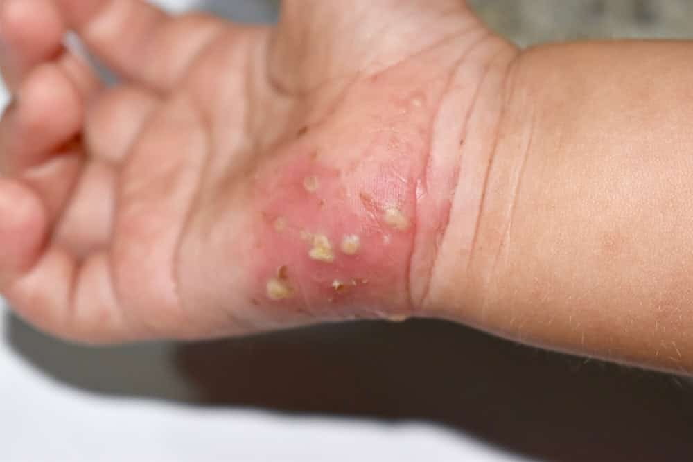 Scabies Infestation with secondary or superimposed bacterial infection in right hand of Southeast Asian, Burmese Child. A contagious skin condition caused by mites. Main symptom is intense itching.