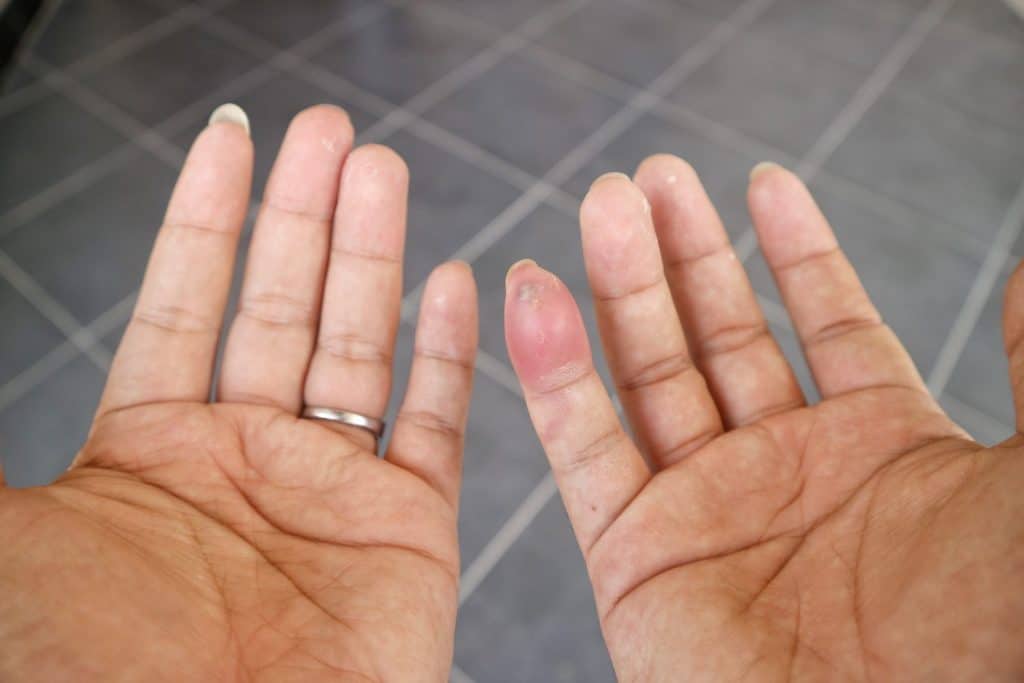 The little finger is swollen. This wound is produced by the bite of a poisonous spider. The effects produced from these poisons include pain, burning sensation, dizziness and nausea.
