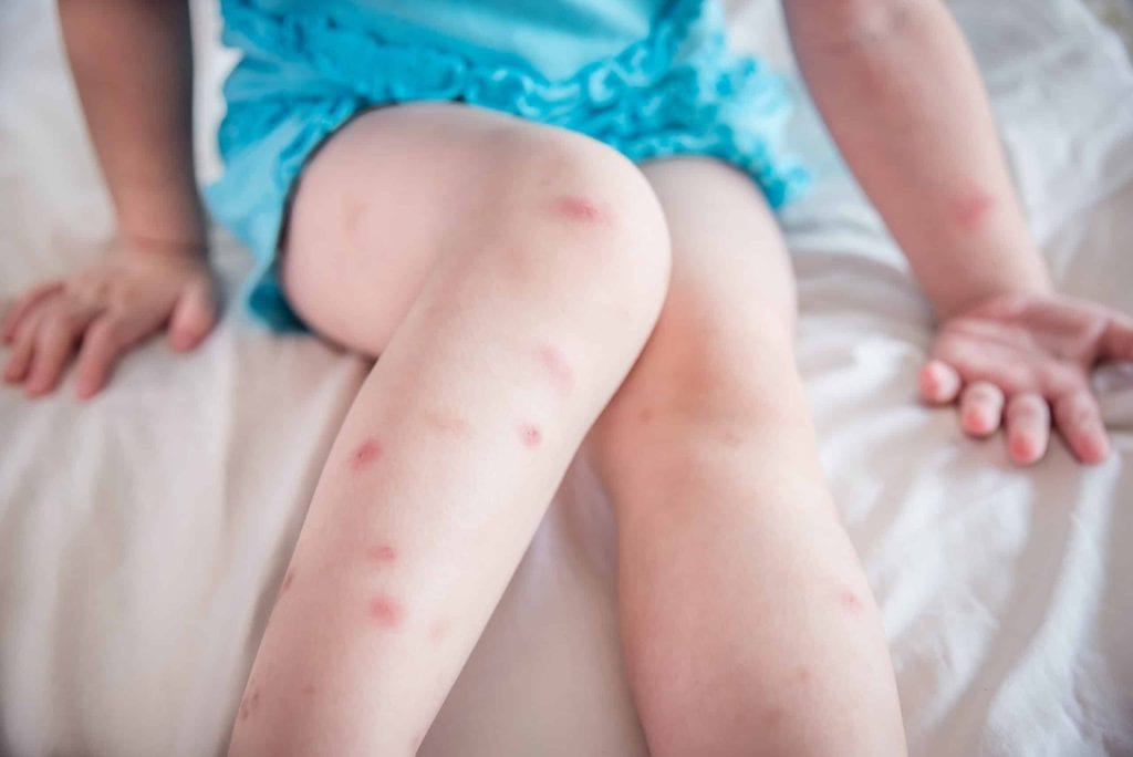 Many of mosquito bites sore and scar on little child legs who sitting on bed