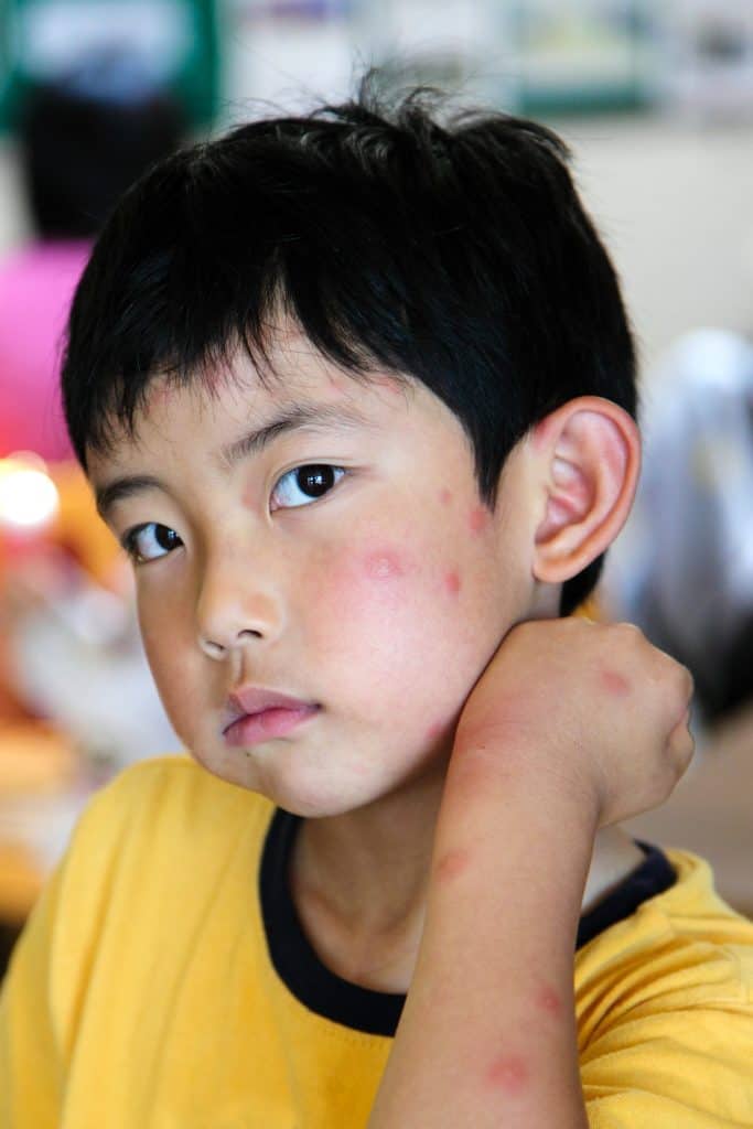 Boy with multiple mosquito bites on face and arm