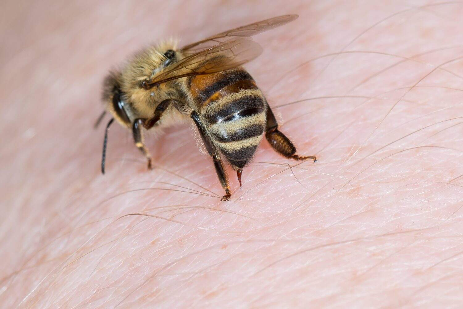 Bee stings in the hand of a person