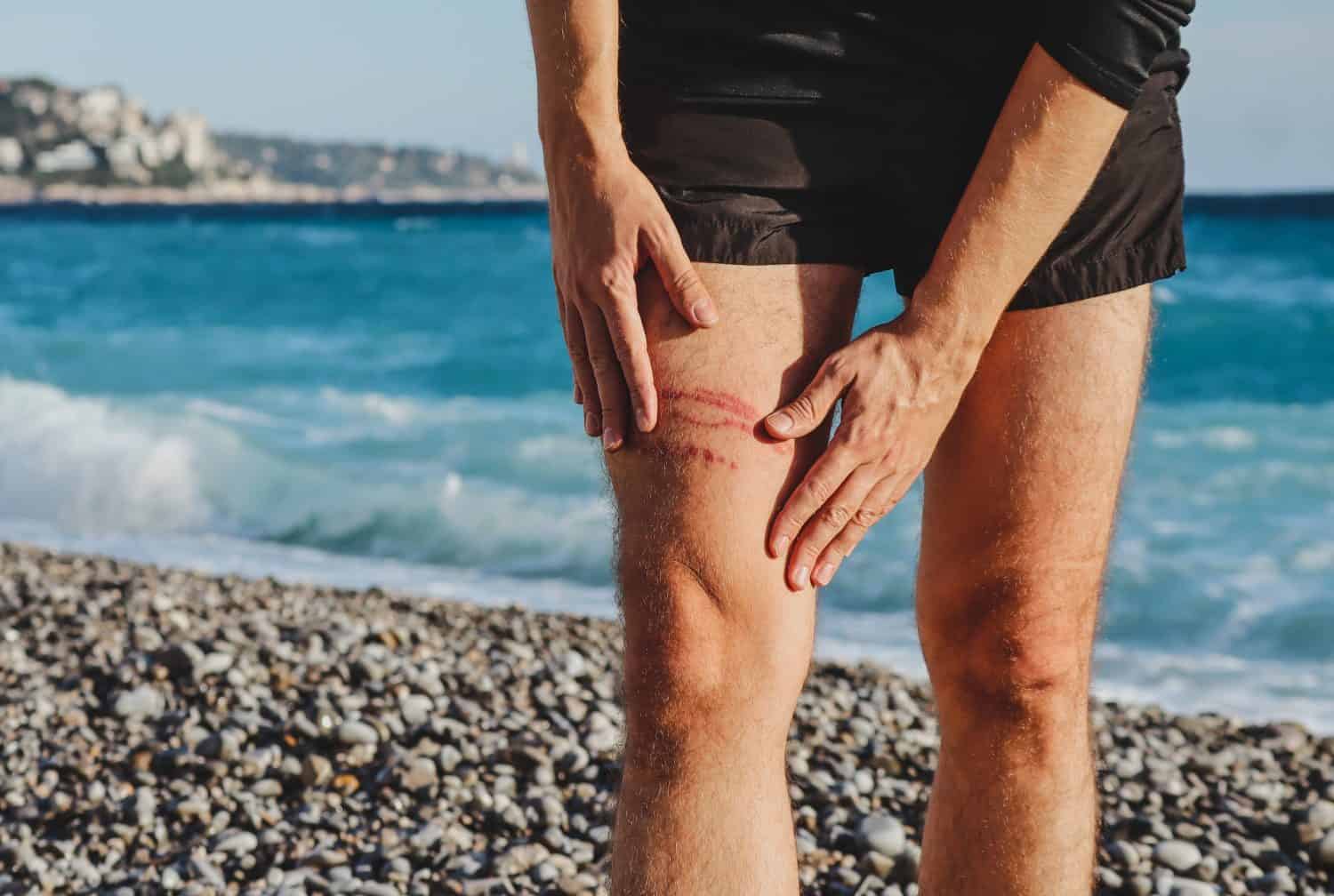 A jellyfish sting burn on a man's leg, on the beach