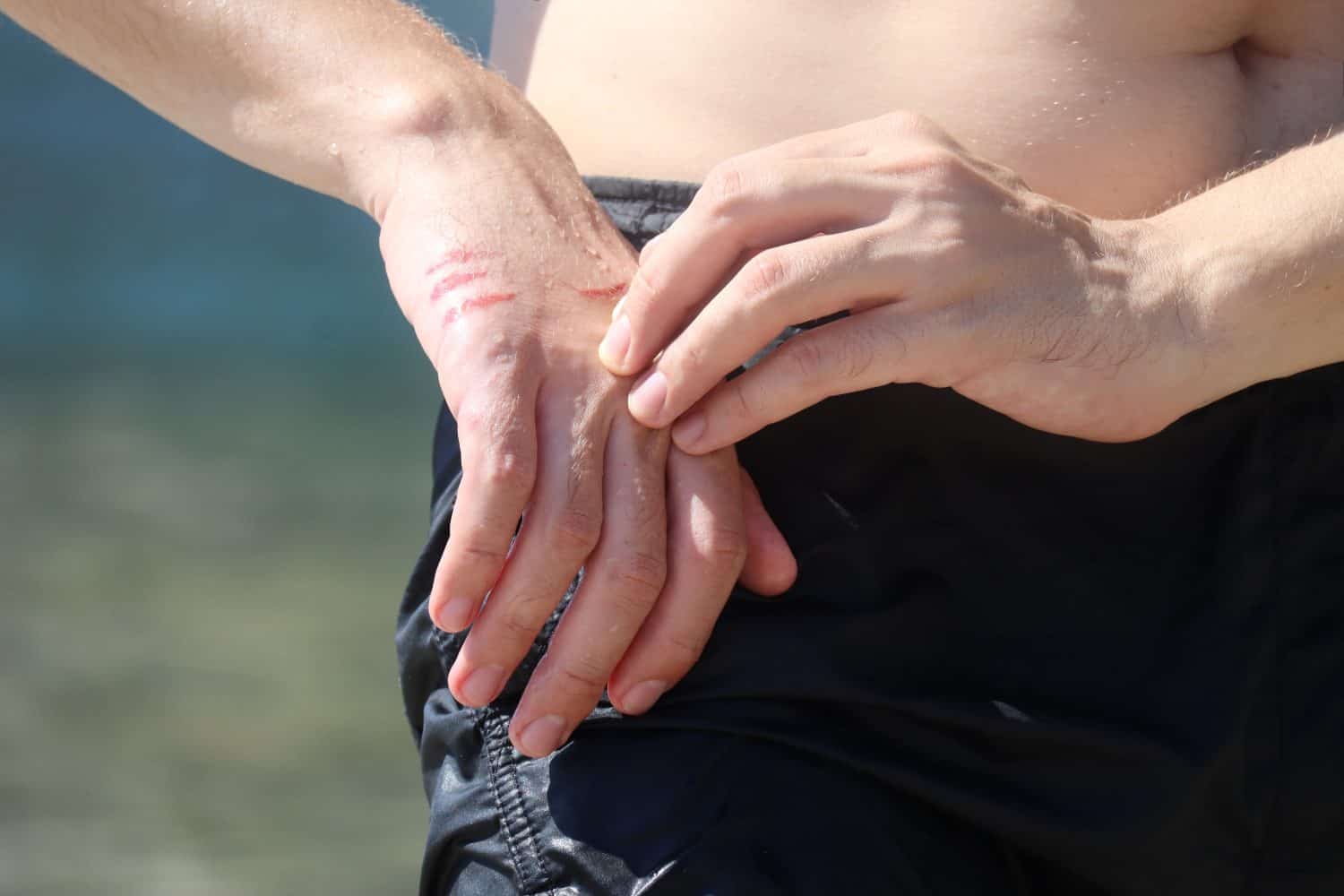 A jellyfish sting burn on a man's hand, on the beach