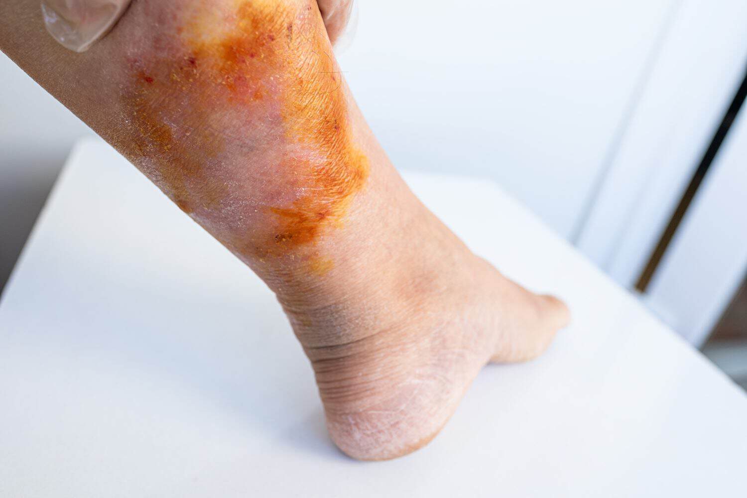 female leg with red jellyfish stings. Painful marine encounter. Beach safety awareness. Medical emergency on vacation. Ocean hazards, Vacation interrupted, stinging cells