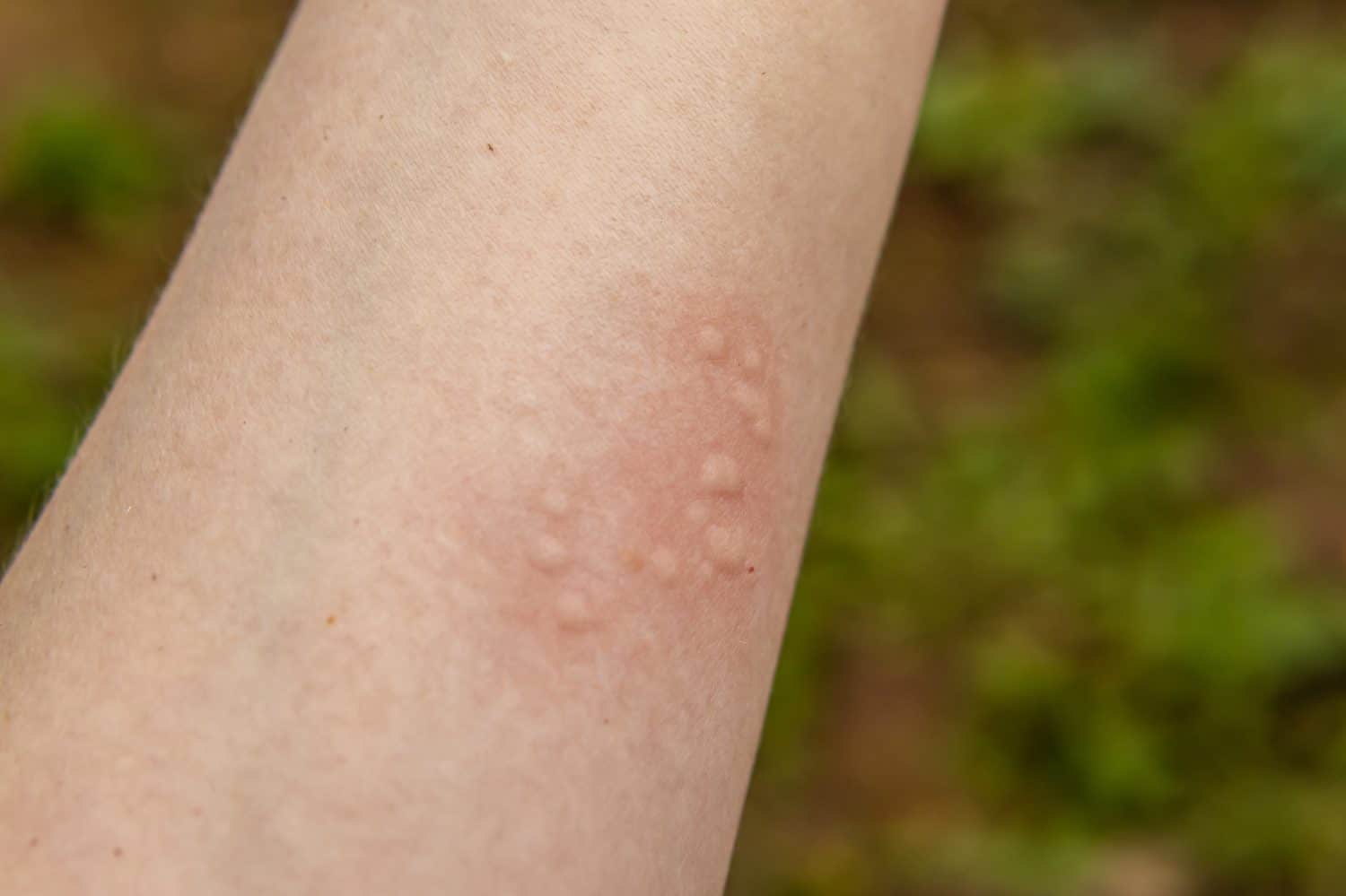 Red spots on the arm. Nettle burn. Allergic reaction on skin. Natural